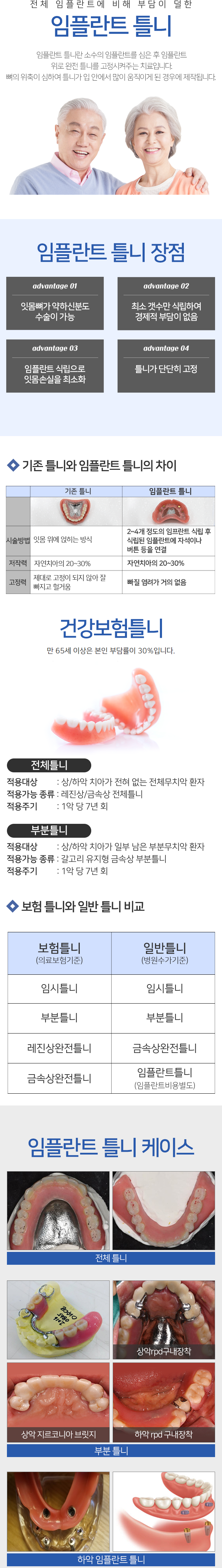 임플란트 틀니