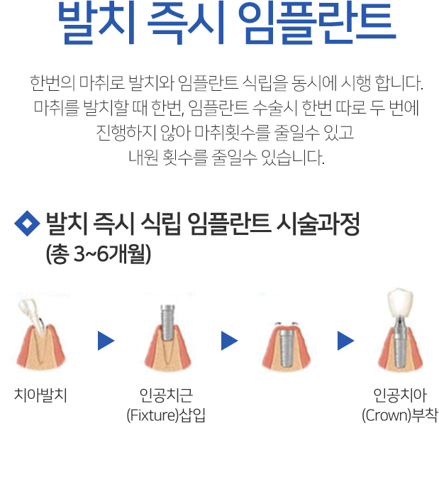 발치즉시 임플란트