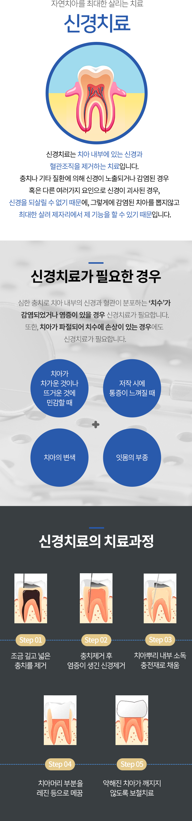 신경치료가 필요한경우, 신경치료 치료과정