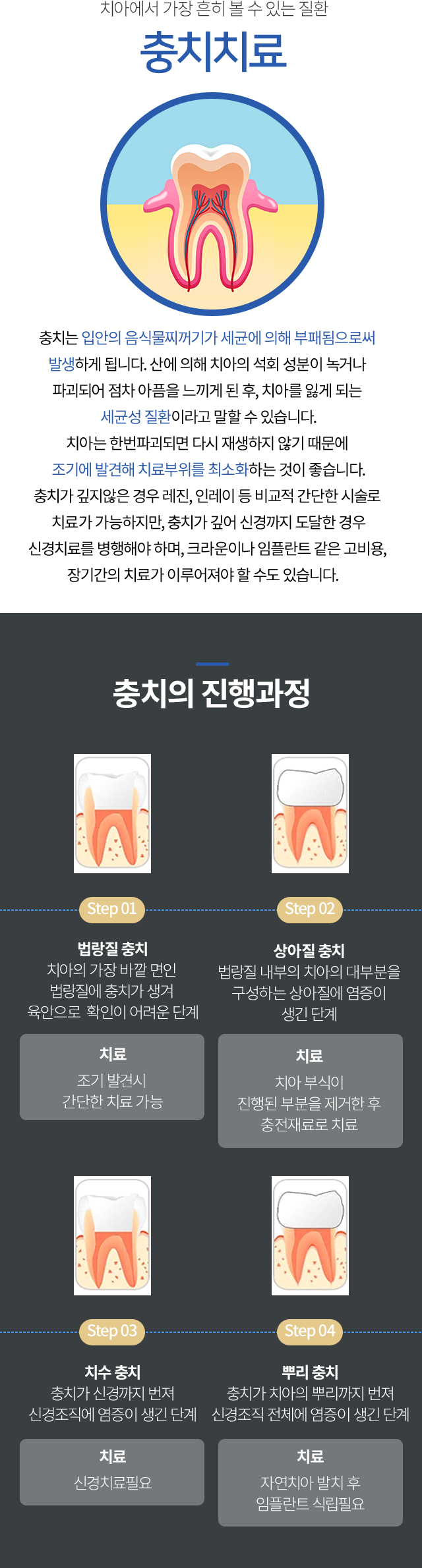충치의 진행과정