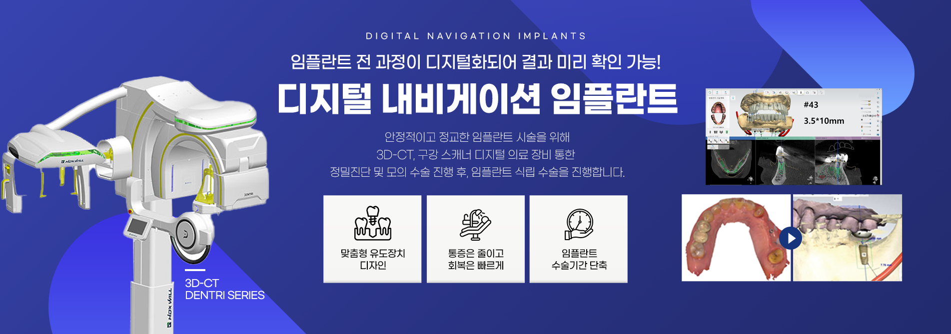 디지털 네비게이션 임플란트