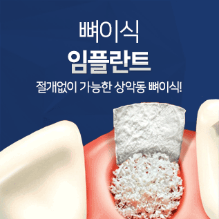 뼈이식 임플란트