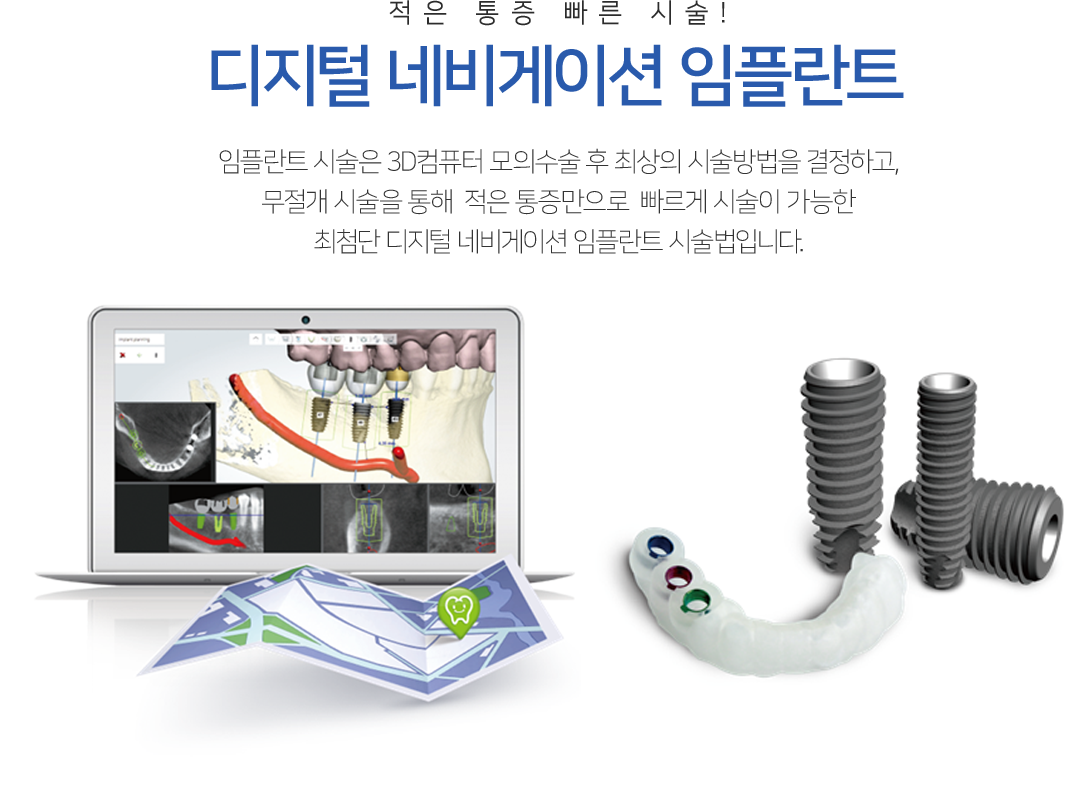 전체임플란트