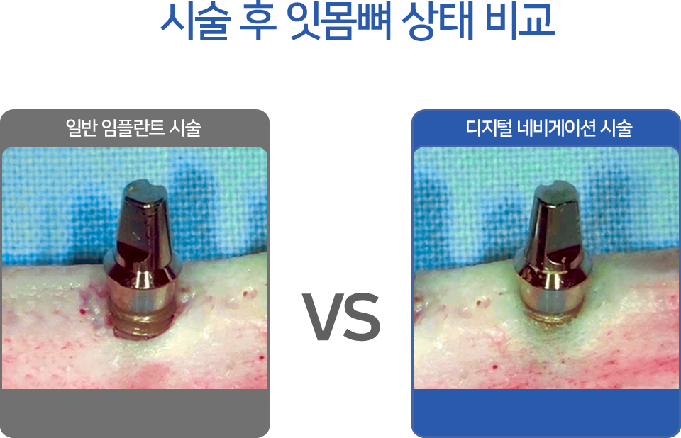 전체 임플란드 비포에프터