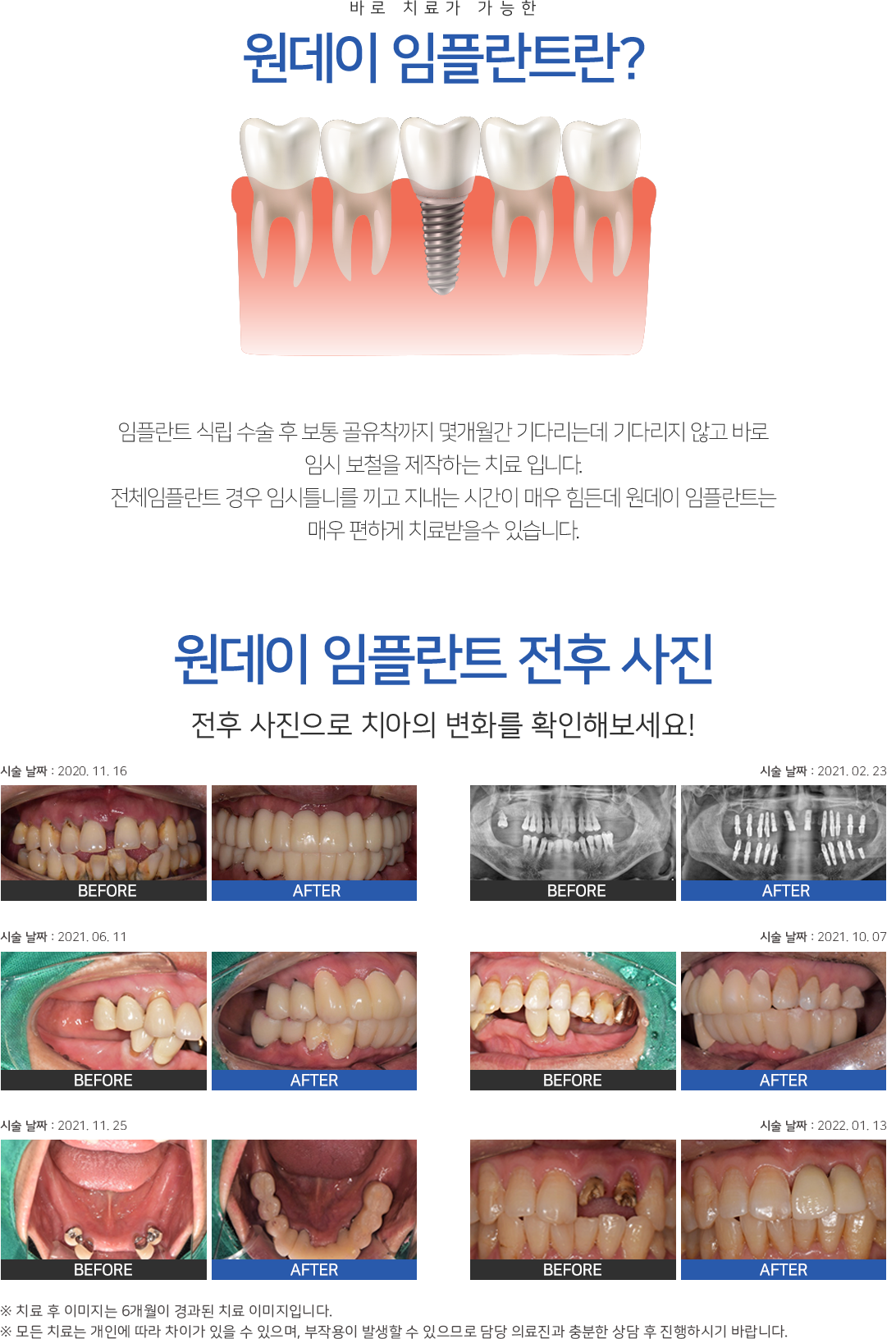 즉시 보철 임플란트란?