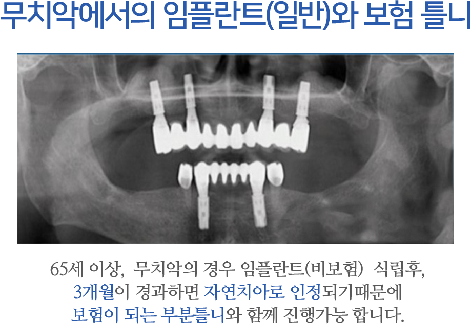 부치악에서의 임플란트(일반)와 보험틀니