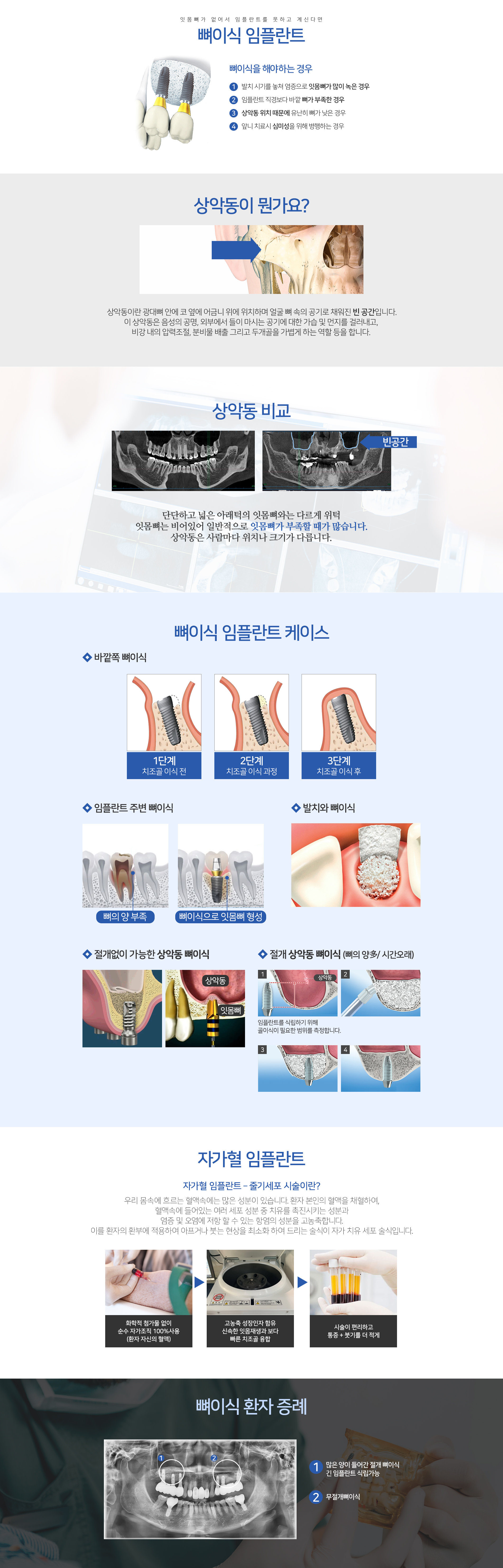뼈 이식 임플란트