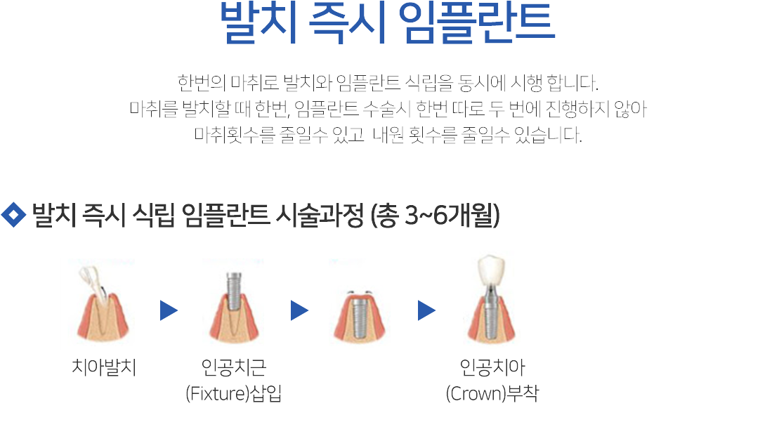 발치즉시 임플란트