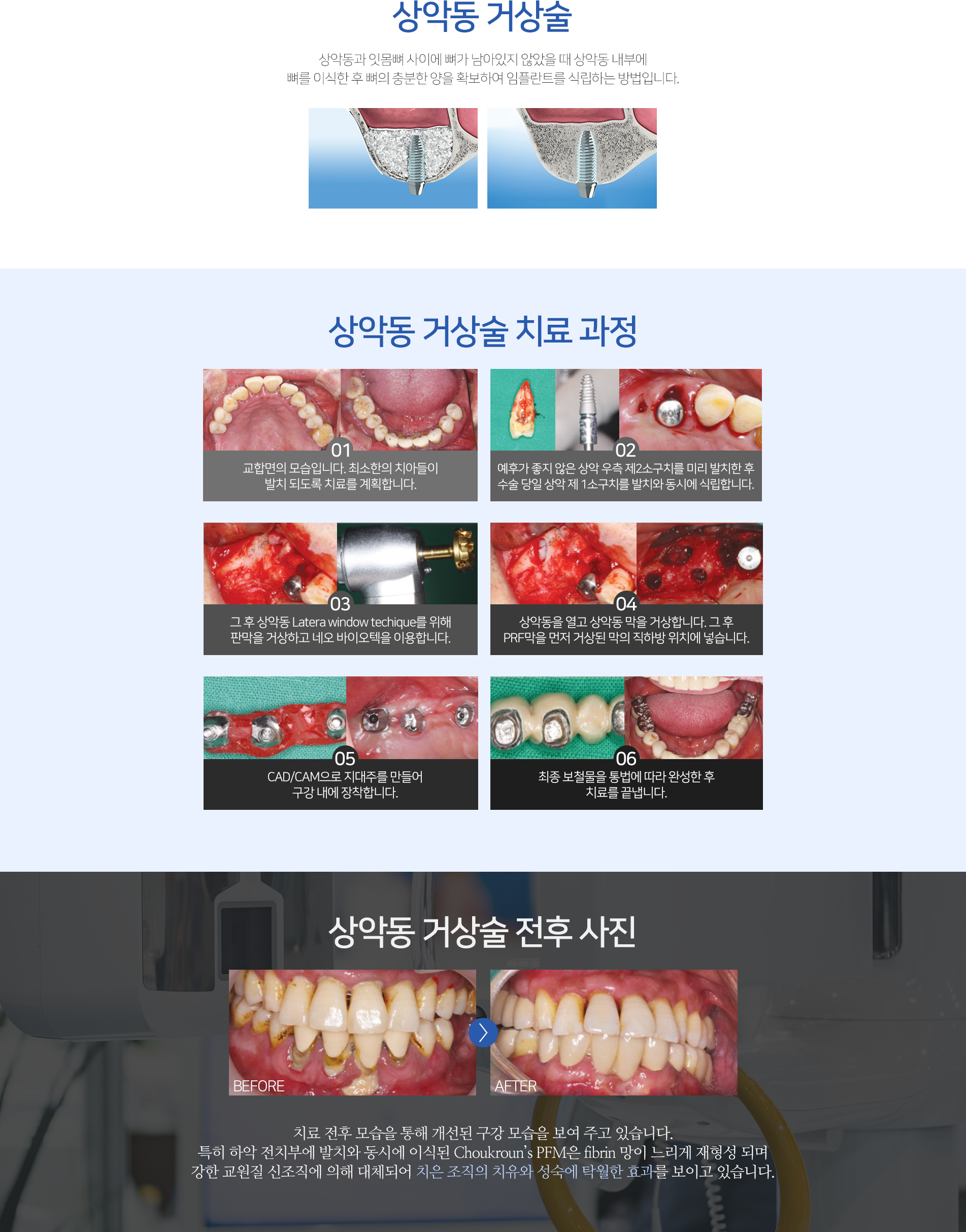 상악동 거상술