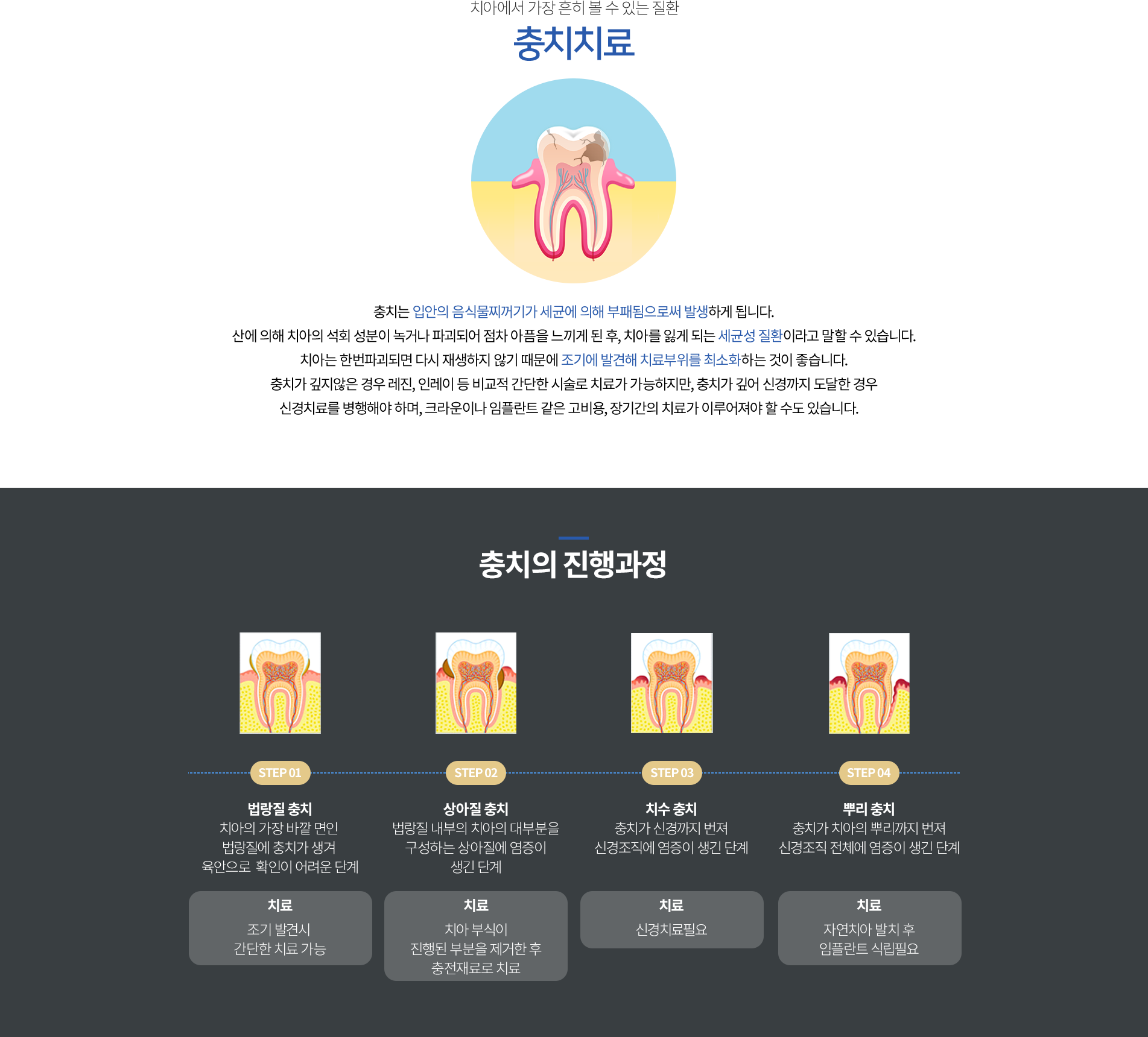충치의 진행과정