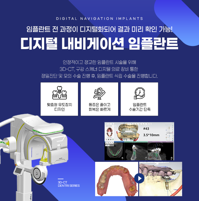디지털 네비게이션 임플란트