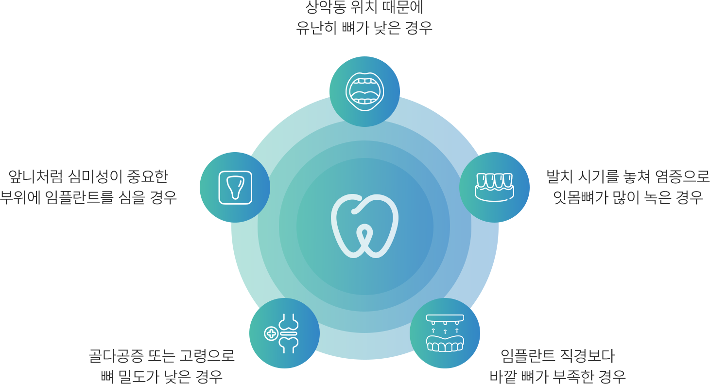 뼈이식임 플란트 대상자