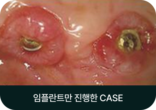 임플란트만 진행한 CASE